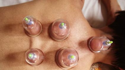 巧用拔罐法,轻松逼出体内湿气!