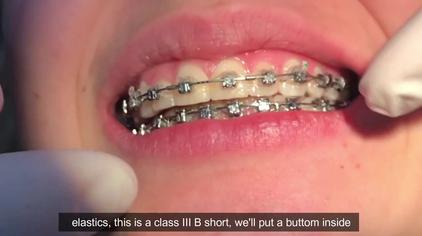 矫正牙齿直接弄一条线可以吗视频在线观看 西瓜视频
